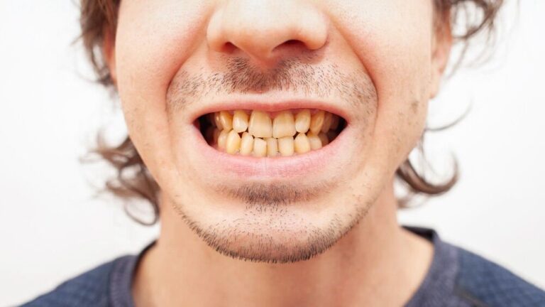 come nascondere i denti brutti