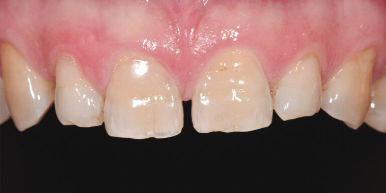 Blog 4 le-faccette-step1-csdb