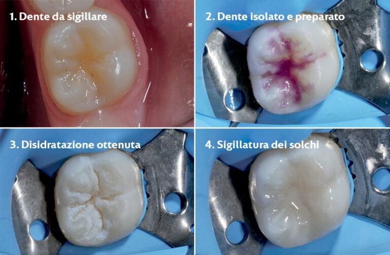 Blog 5 Clinica Sorriso del Bambino - Dentista a Padova, Albignasego